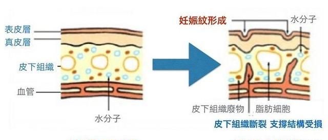 肥胖纹怎么去掉怎么消除图7