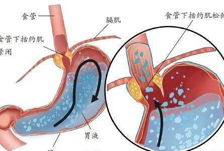 喉咙有灼热感是什么原因(喉咙经常有灼热感是什么情况)图2