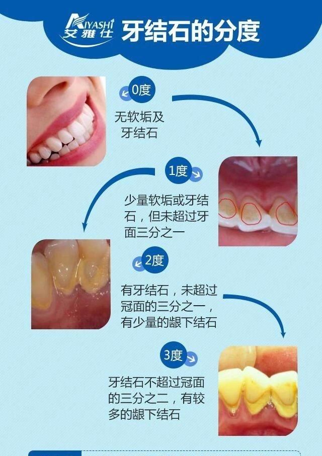 漱口水到底有什么用图3