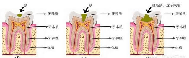 儿童牙齿表面有黑点怎么办,3岁儿童牙齿中间有个黑点图1