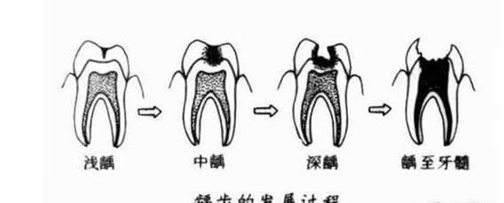 儿童牙齿表面有黑点怎么办,3岁儿童牙齿中间有个黑点图3