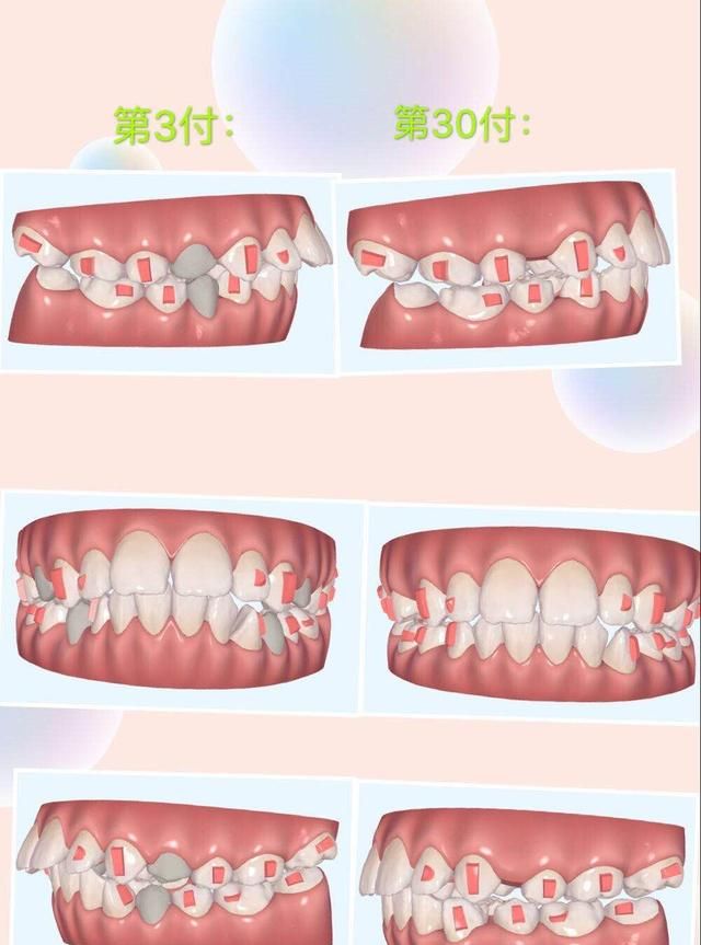 隐适美牙套可靠吗图4