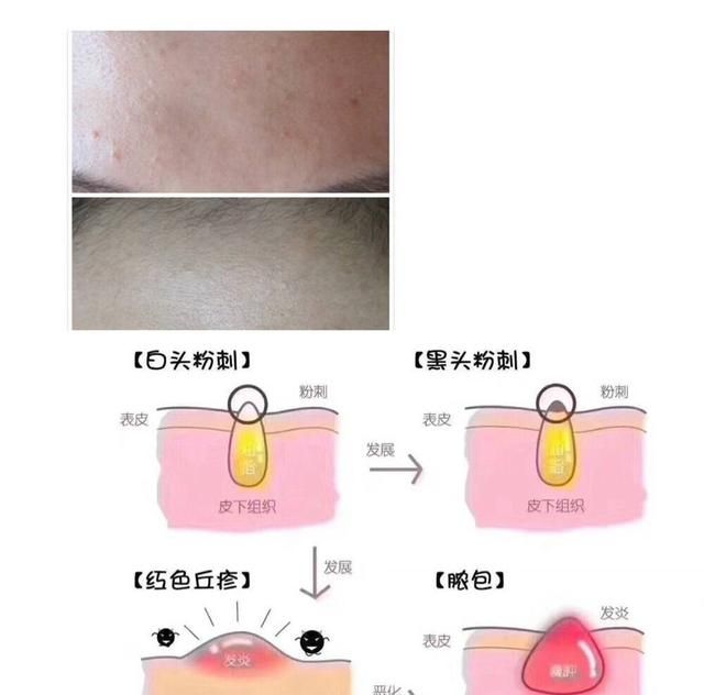 怎么样才能祛痘(怎么样才能祛痘印效果好)图2