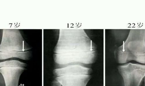 为什么成年人就不能再长高(手骨骺线闭合就代表不能再长高吗)图2