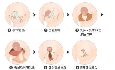 怎么可以让胸部变小图5