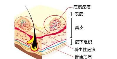 疤痕体质的人如何祛疤图2