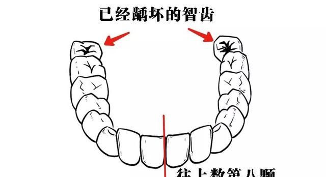 什么是智齿智齿需要拔除吗(下颌智齿比上颌智齿难拔吗)图4