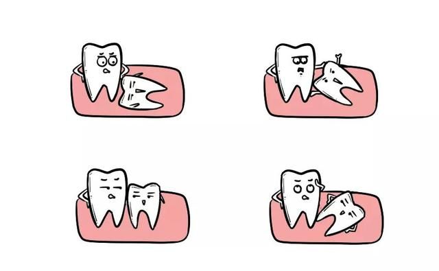 什么是智齿智齿需要拔除吗(下颌智齿比上颌智齿难拔吗)图5