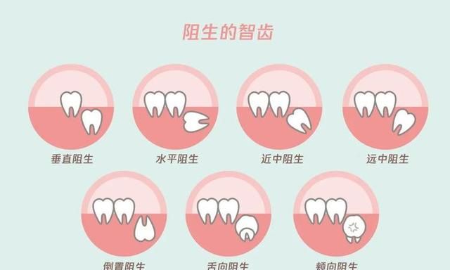 什么是智齿智齿需要拔除吗(下颌智齿比上颌智齿难拔吗)图11