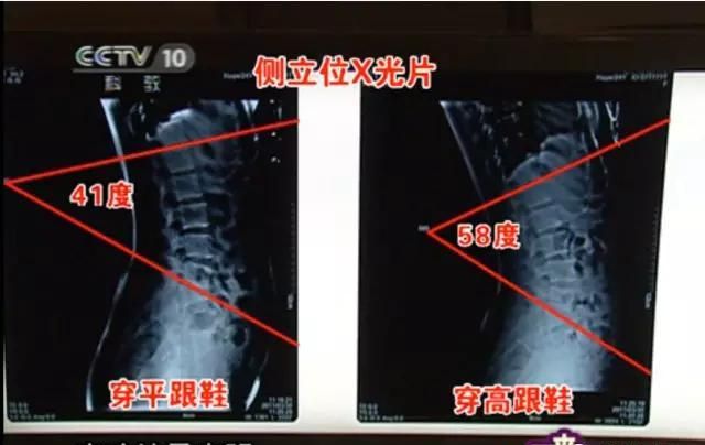 女人穿高跟鞋的危害有哪些(女人经常穿高跟鞋有什么害处)图17