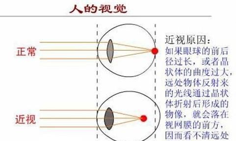 怎么选合适自己的近视镜图1