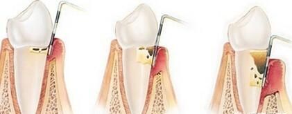 患有牙周炎该怎么办图1