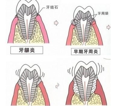 患有牙周炎该怎么办图2