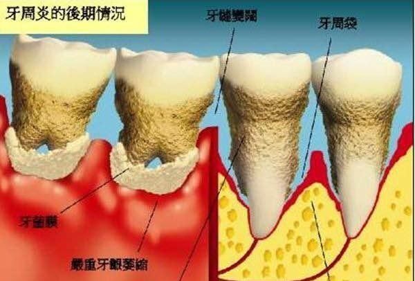 患有牙周炎该怎么办图5