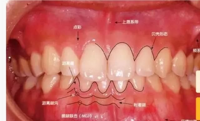 患有牙周炎该怎么办图6