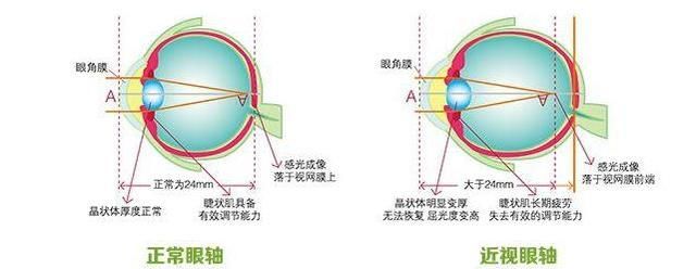 为什么戴眼镜眼睛会变形,戴眼镜眼睛变形对比图图4